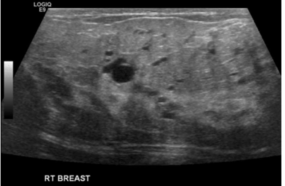 Dense lactational tissue with slightly dilated ducts consistent with lactation and a very small galactocele that resolved with treatment of hyperlactation.