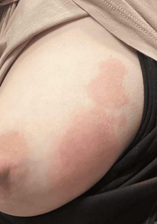 Not all things red are infectious: Skin burn from heat, not mastitis.