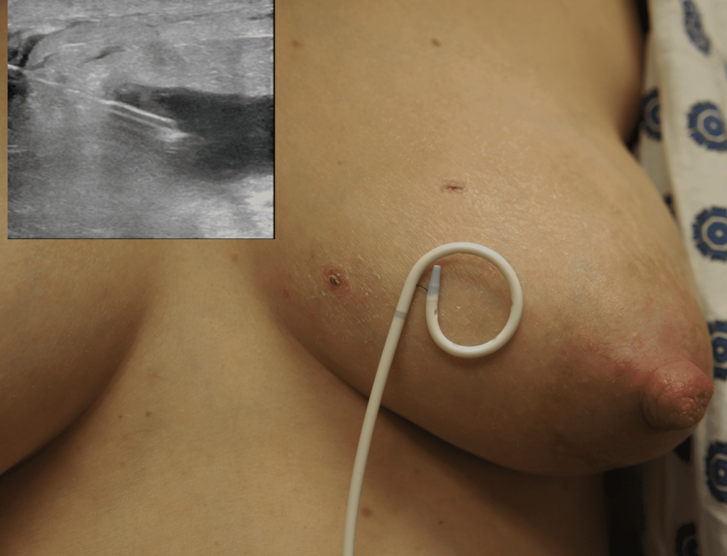 If a minimally invasive surgical office procedure is not available, then patients should proceed to interventional radiology drain placement. This image shows an abscess appearance on ultrasound as well as the the small skin defect created by the small pigtail catheter drain.