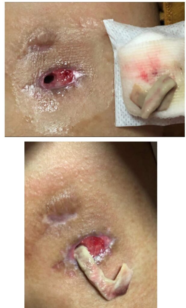 Patient with milk fistula formation as a result of packing tape being used twice daily, which caused increased inflammation and prolonged wound healing time.
