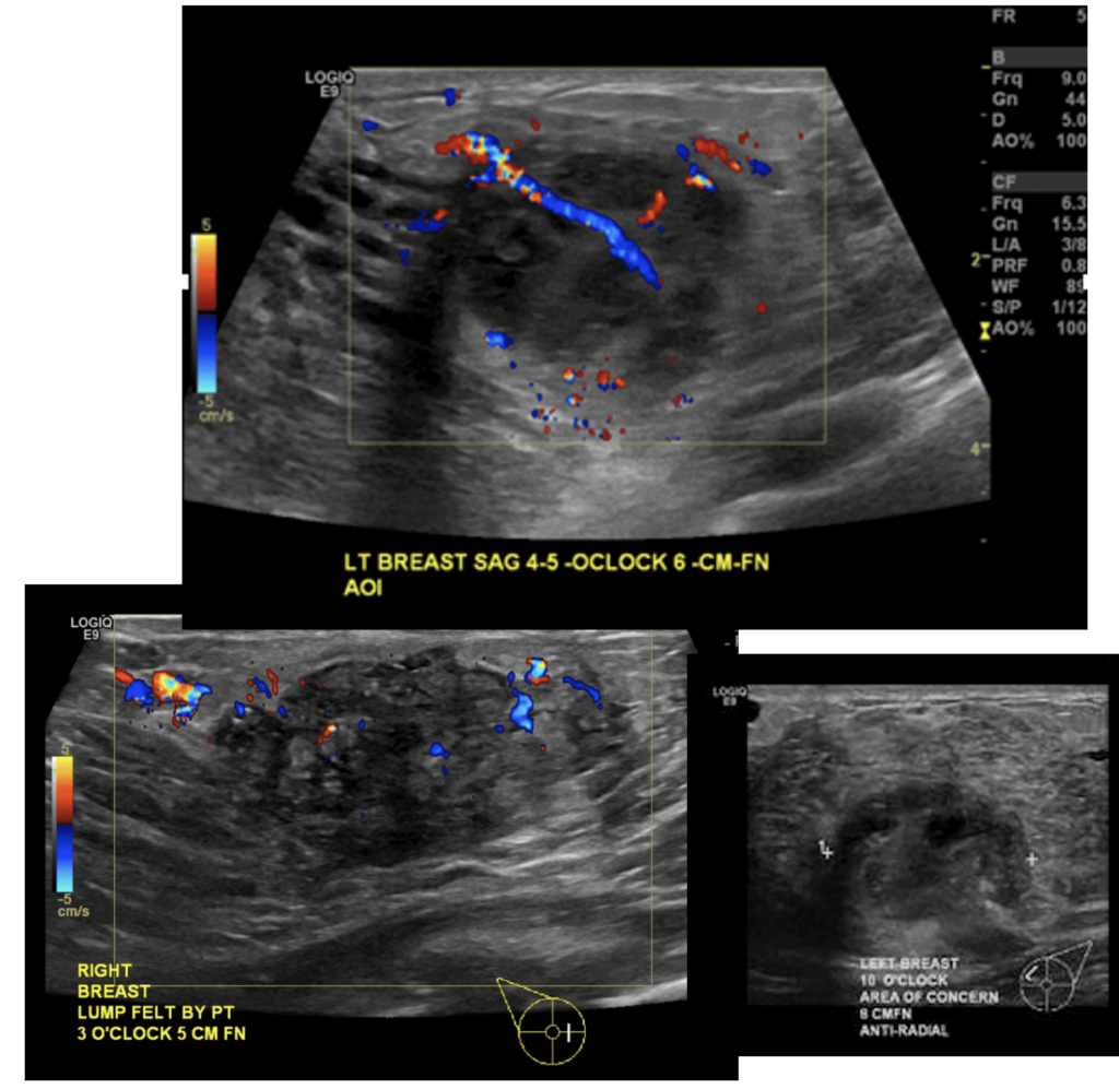 Ultrasound appearance of lactational phlegmon, with indistinct fluid and hypervascularity.