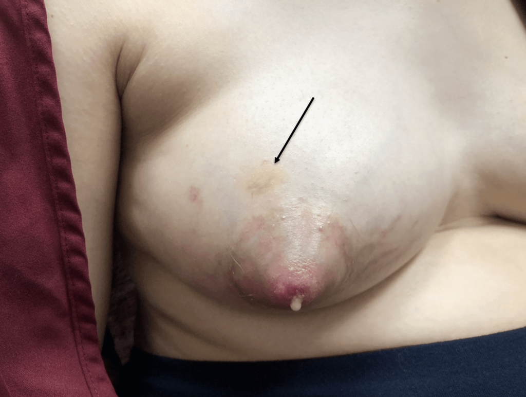 Breast bruising from massage