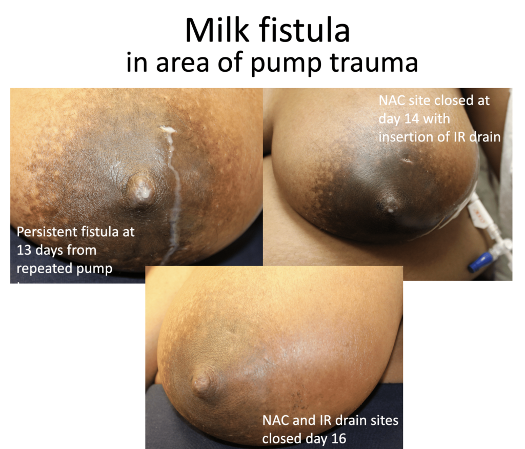 It is sometimes necessary to place an incision near the nipple and areola to achieve adequate drainage of a fluid collection. This patient underwent a procedure that was effective for resolving the abscess behind her nipple and areola. However, the infant did not like the swelling in this breast and mom pumped to maintain her milk production while feeding the baby on the opposite breast. At two weeks after presentation, the patient underwent a drainage procedure by interventional radiology (which utilizes radiology images to place a drain and allows for placement far from the site of concern) that diverted the flow of milk. Within 24 hours, her fistula had closed.