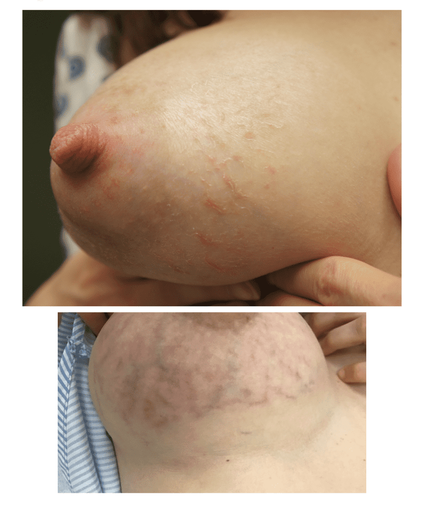 PUPPP and hives on breast