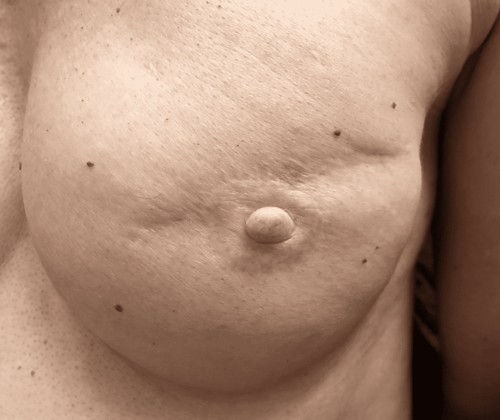 nipple reconstruction after mastectomy