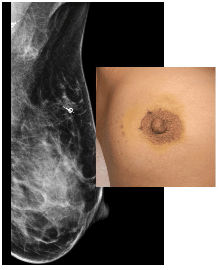 Mammogram showing localization of mass and lymph node for removal as well as skin marking for lumpectomy incision.