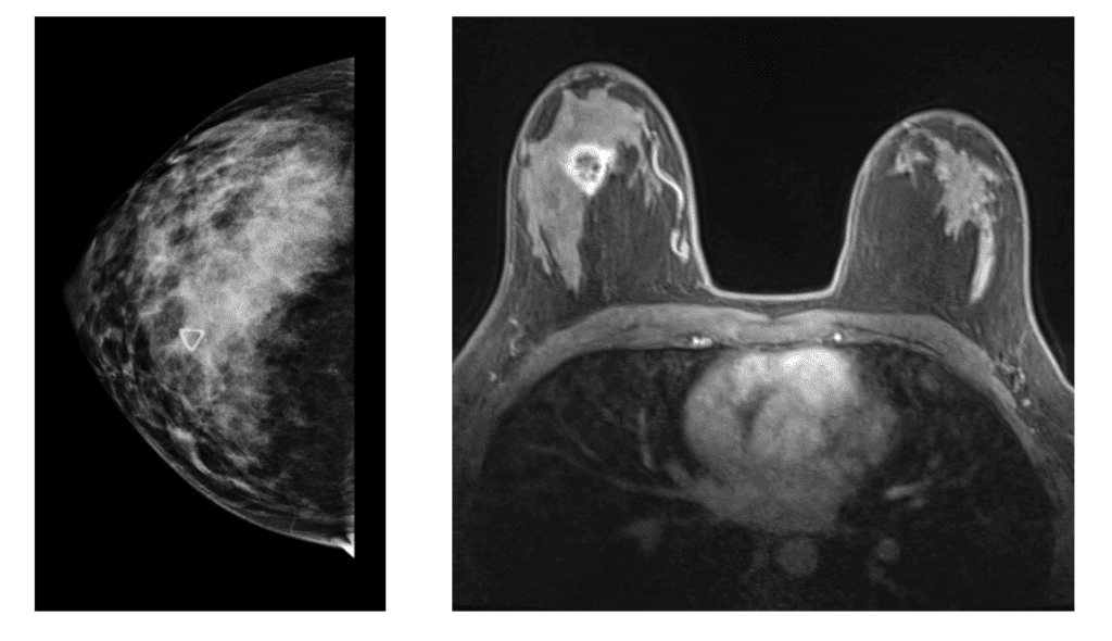 Mammogram sales while breastfeeding