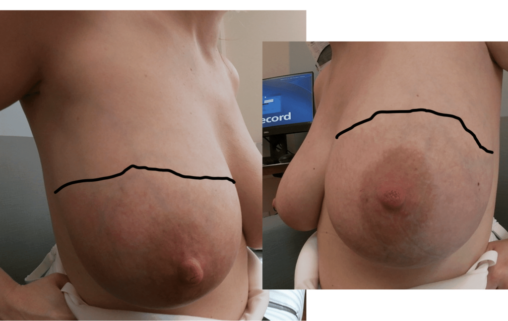 Faint redness, swelling, and pain in a symmetric fashion in lower (dependent) portions of both breasts from breast growth and engorgement