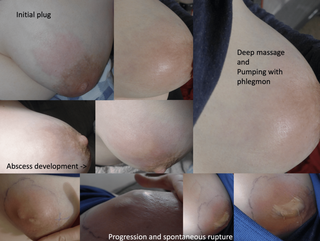 Representation of progression of initial plug, to deep massage and pumping with phlegmon to abscess development to progression and spontaneous rupture