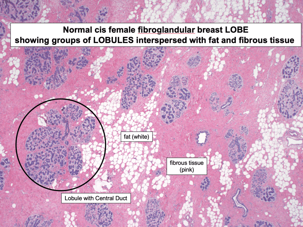 Normal cis female fibroglandular breast LOBE showing groups of LOBULES interspersed with fat and fibrous tissue