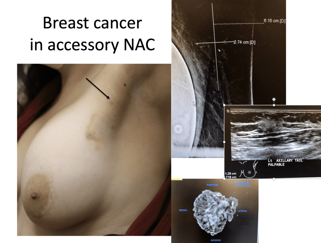 Changes in Breastfeeding and of Breasts before and after Babies' Surgeries  for Ankyloglossia with Deviation of the Epiglottis and Larynx (ADEL)  —Healthy Breastfeedin