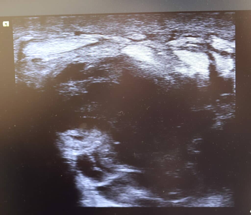 Abscess viewed on ultrasound