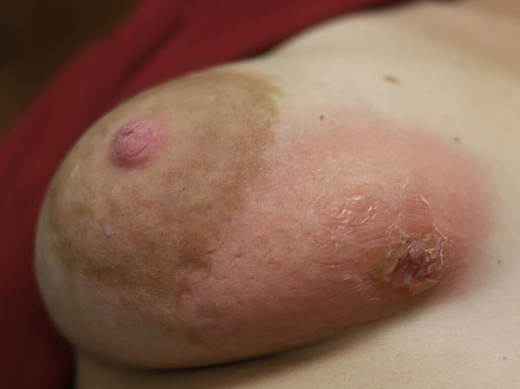 Right breast abscess after massage with spontaneous drainage of fluid