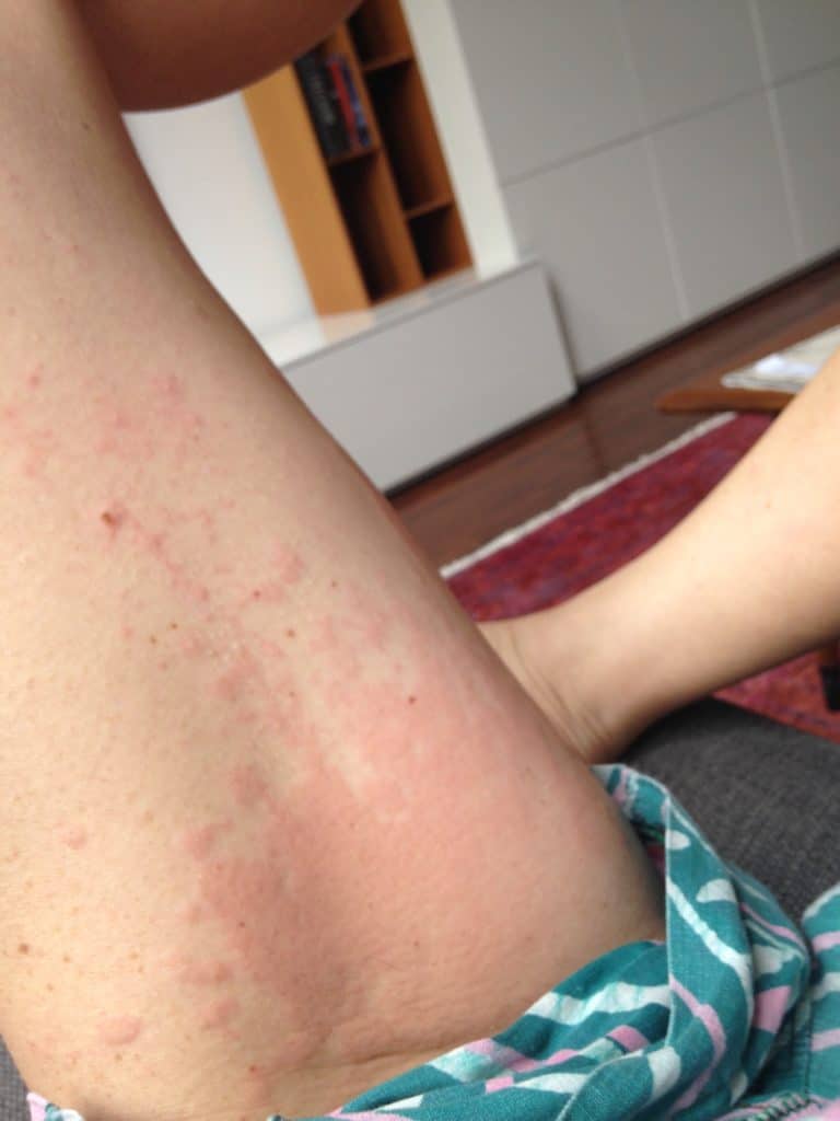 Hives on leg