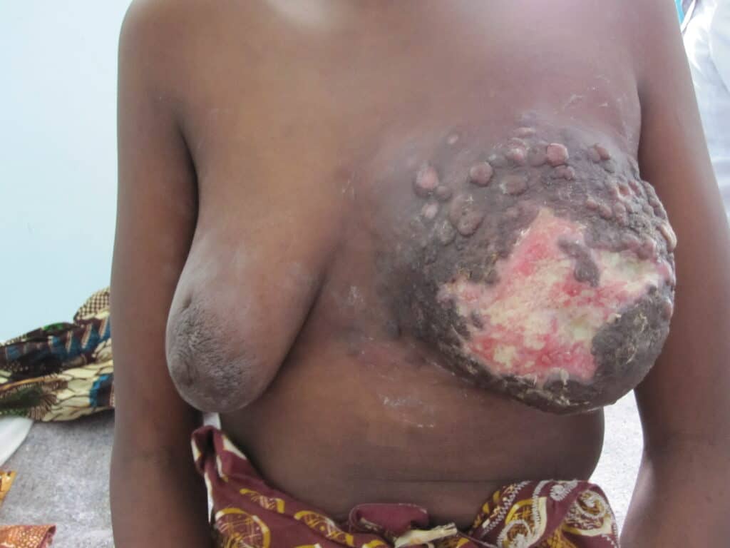 Inflammatory breast cancer with ulceration and modularity of skin