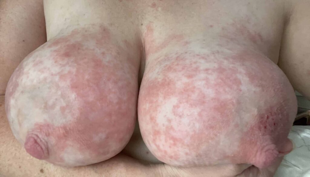 Severe dermatitis in mom with history of eczema, NOT YEAST.
