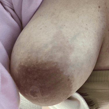 Early mastitis with streaking