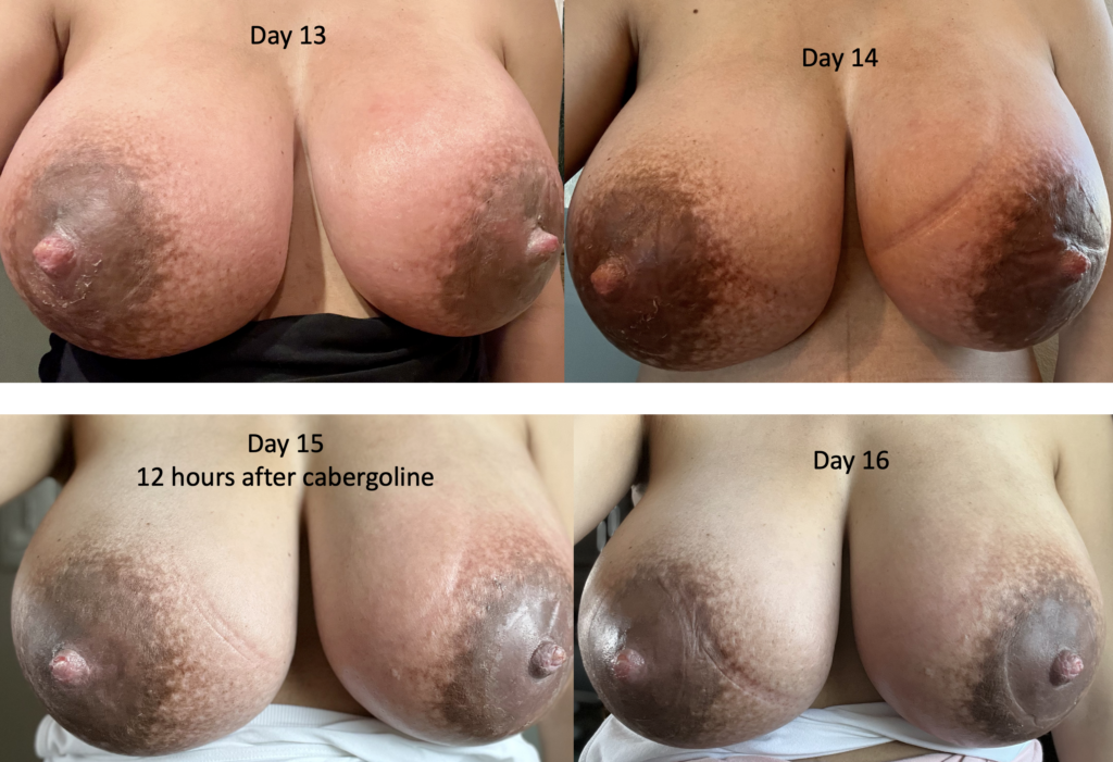 Allergy Swollen Tits - Mastitis, Engorgement, and Breast Complications (with Images)