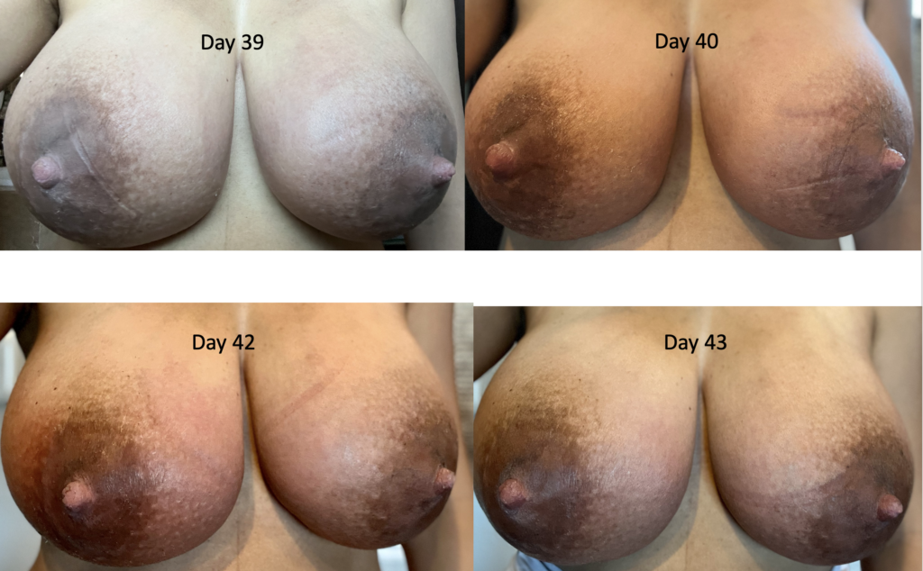 Breast Engorgement Porn - Mastitis, Engorgement, and Breast Complications (with Images)