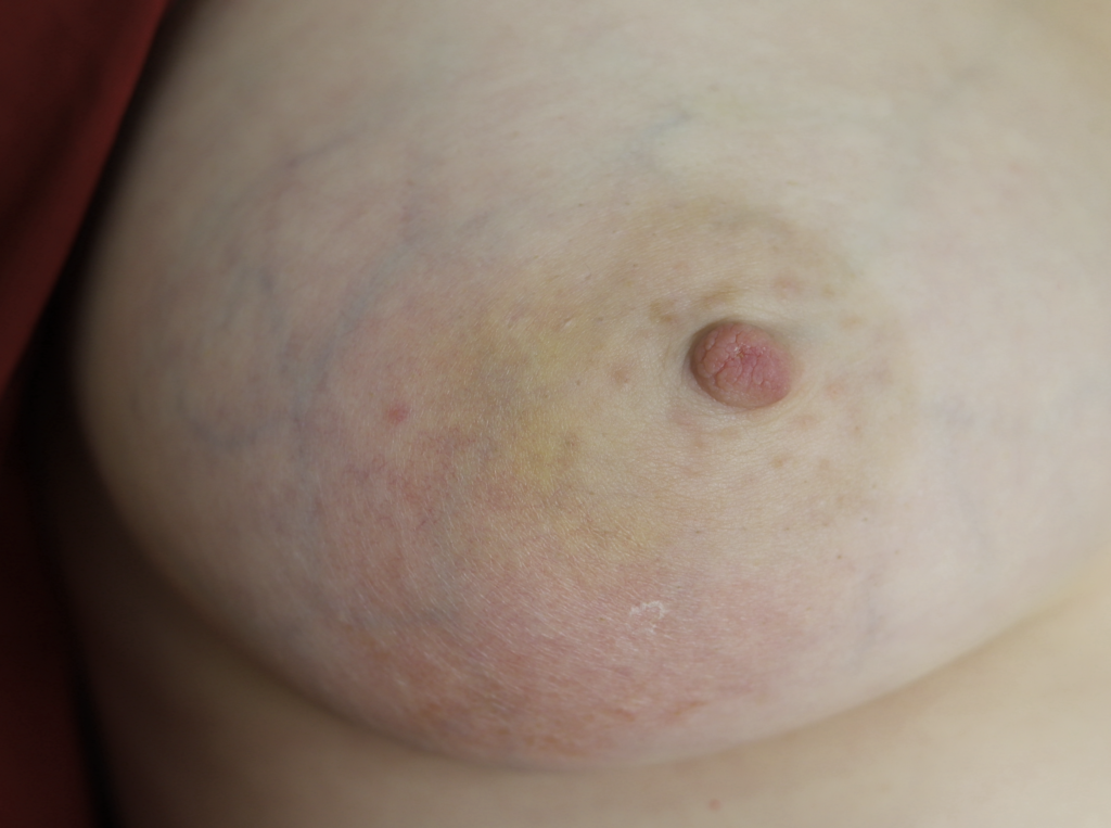 Nipple Problems & Disorders in Women