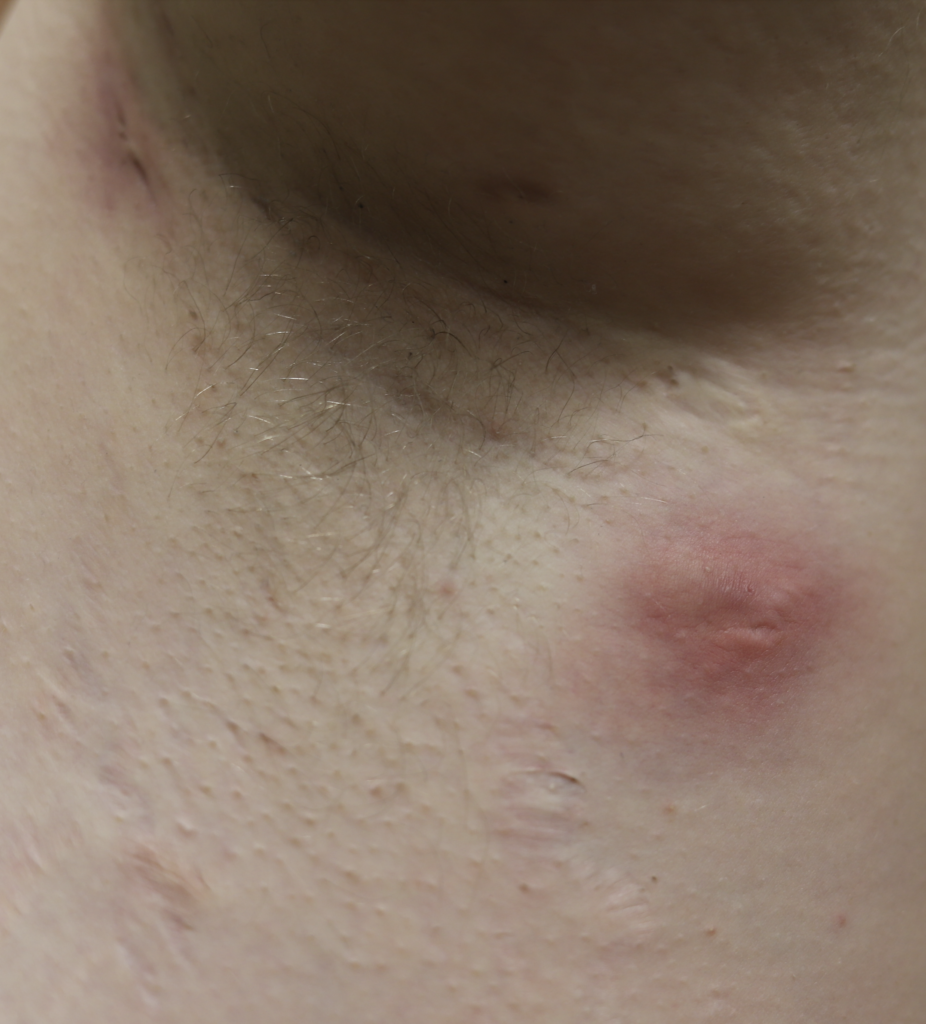 Hidradenitis Suppurativa on and Under the Breasts: Symptoms and