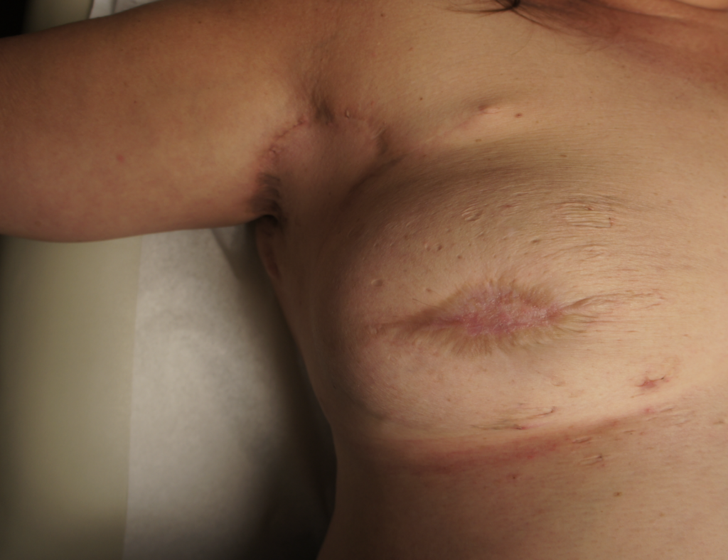 Hidradenitis after excision and scarring and mobility limitations