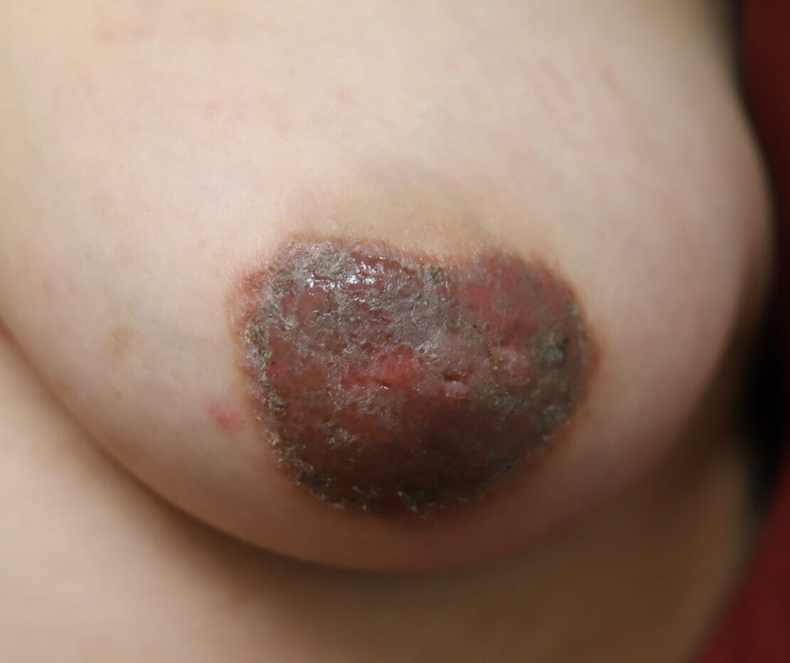 severe dermatitis from nipple piercing use this one scaled e1666385232770