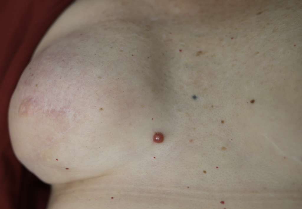 Breast cancer recurrence red nodule