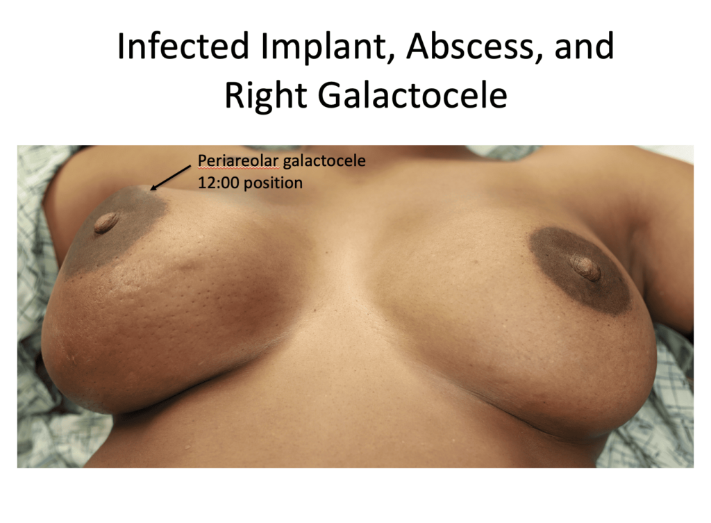 infected breast implant in lactation