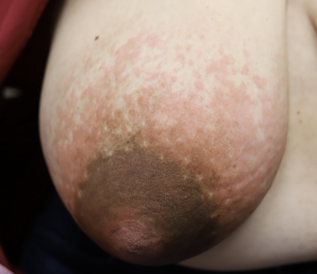 Strange Rash on breasts? picture included - Breastfeeding
