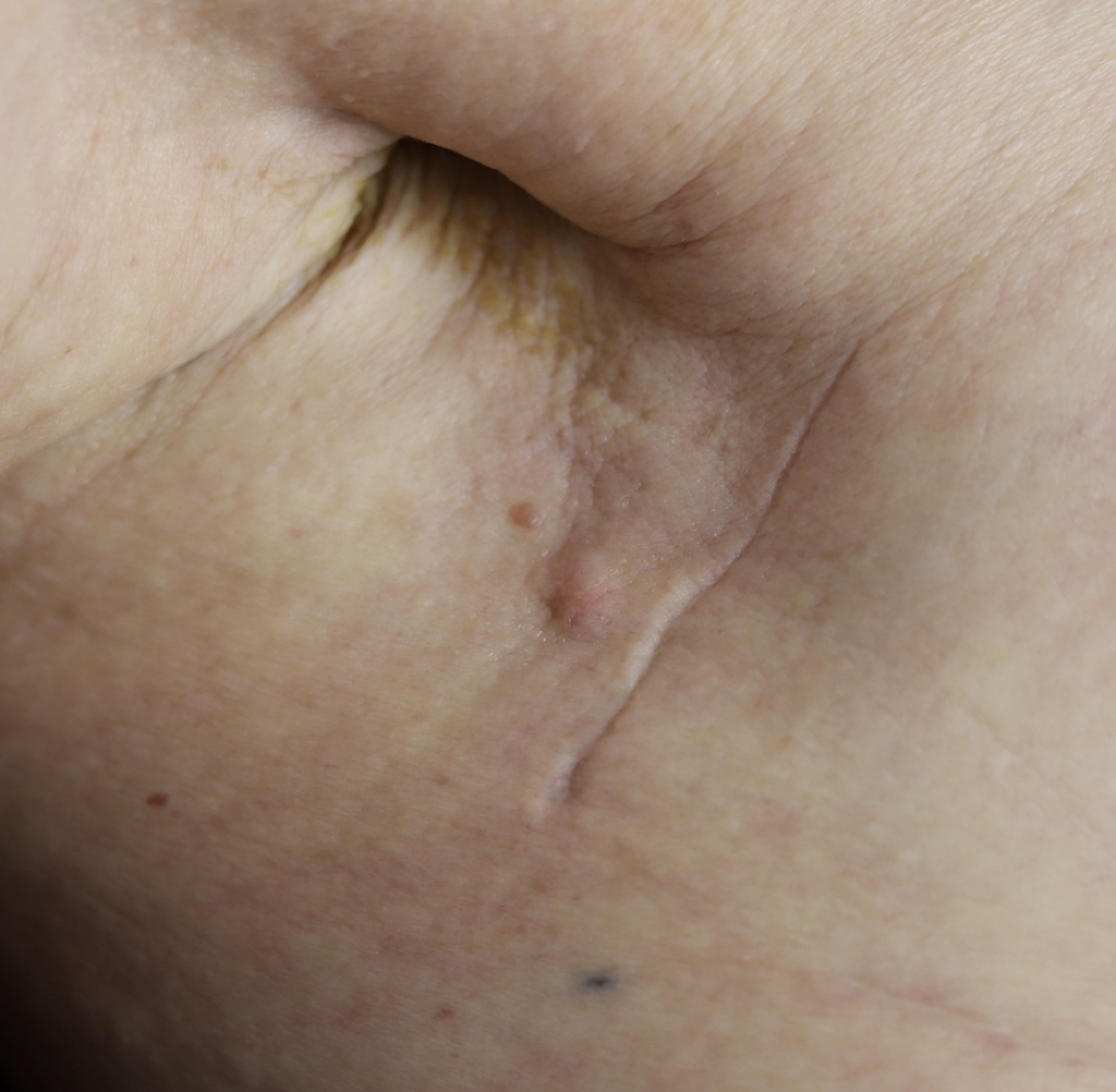Breast cancer recurrence at sentinel lymph node biopsy site
