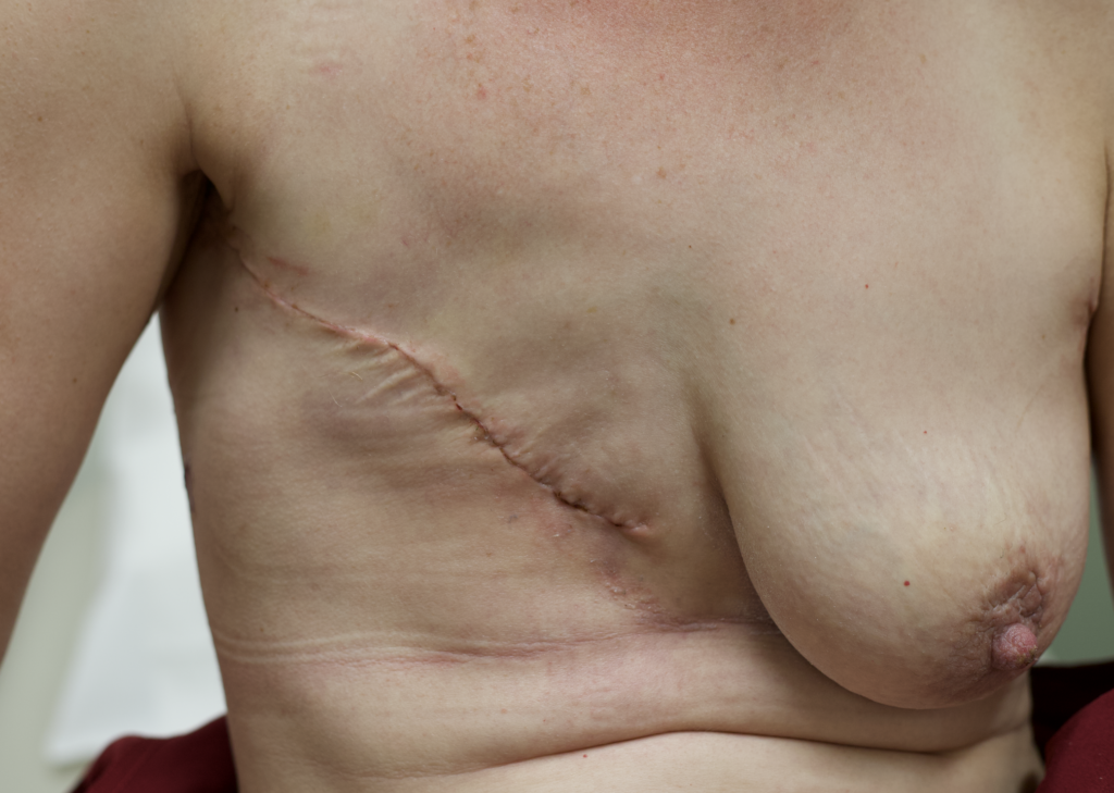 Unilateral mastectomy 10 days post op